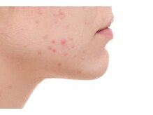 【肌別本格コース】】赤・白・黄 タイプに合わせたニキビケア♪毛穴の汚れや・黒ずみが気になる方にも◎