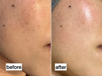 サロンリー(Salon Riee)/シミ改善しながら肌改善も