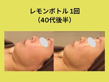 アユアラングレース/レモンボトル1回