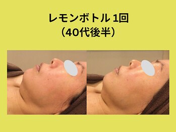 アユアラングレース/レモンボトル1回