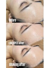 ラクシー 船橋(luxssy)/お顔シェービング×ララピール