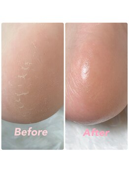 最新機器フットケア¥¥5000