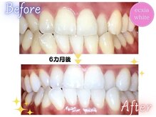 エクシアホワイトニング 天王寺店/ホワイトニングビフォーアフター