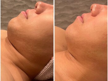 ビュウナ 銀座(BEAUNA)/マルチウェーブリフト