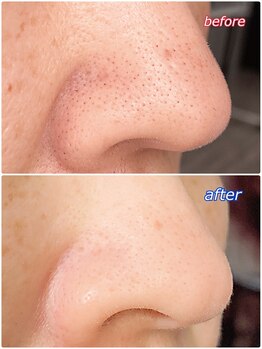 KMB 恵比寿店/大人気毛穴洗浄☆