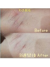 RiとBiのたまご/（脱毛）　ワキ脱毛　3週間