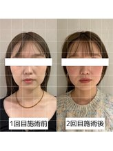 ヴィーライン 大阪梅田院(VeLine)/鍼灸／美容鍼／小顔／大阪／梅田