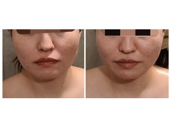 ウォーマル(warmaL)/小顔矯正/浮腫み撃退！