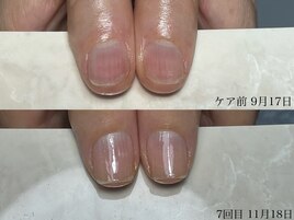 自爪育成 3ヶ月コース