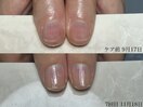 自爪育成 3ヶ月コース