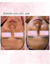 ソワイユ 浜松店(Soyeux)/肌質改善before→after