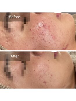 ルナート(Lunart)/ハーブピーリング【顔】