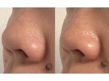 ひっそり美肌構築/ゴワつきざらつきにはMTSが◎