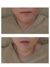 サロンルーチェ(Salon Luce)/フェイスラインのむくみ