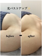 メディカルサロンドオフ 堺東店(medical salon de off)/光バストアップメニュー♪前後