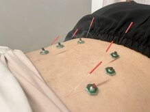 京美/施術風景【鍼灸】