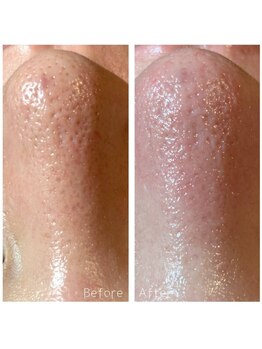 ポピン(POPIN)/≪毛穴洗浄≫水光アクアピール