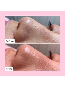 ホワイトラボ 四条烏丸(White labo)/【施術例】ハイドロフェイシャル