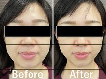 カンナ 福岡(Canna)/速攻小顔が叶う人気メニュー