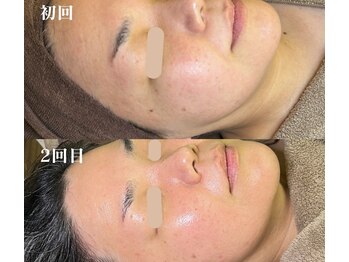 ソルニコン(Solnikon)/陶肌トリートメント