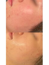 ビジュープラス(Bijou+)/剥離無しハーブピーリング