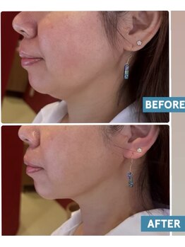 エン(en.)/たるみ改善