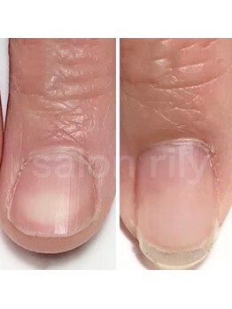 マリーシーオー(MARY-CO.)/深爪矯正