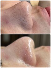 リッシュボーテ(RICHE BEAUTE)/ハーブピーリング＆プラズマ