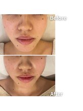 エムボーテ 太田店(M BEAUTE33)/顔筋小顔コルギ