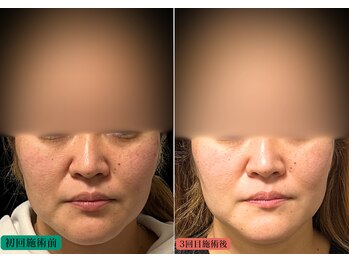 やなけん 亀戸店/美容鍼灸/フェイシャル/小顔