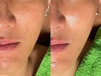 ゾーンビューティーハウス 松戸店(ZONE BEAUTY HOUSE)/メンズ★陶肌トリートメント