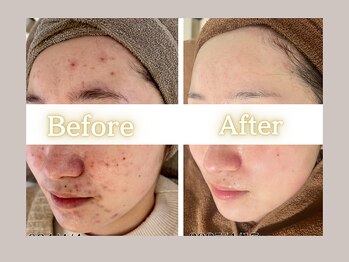 ハル(HARU.)/ハーブピーリング