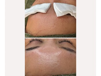 サイ(Sai)/６回目のケアで肌が動き出す