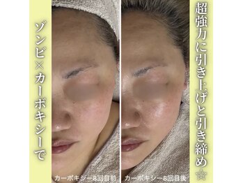 ハニエル(Haniel)/カーボキシー症例