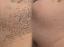 脱毛専門サロン エリクサー(Elixir)/Before After