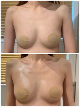 ルナグランデ(Luna grande.)/“増える”豊胸術　カップ数up