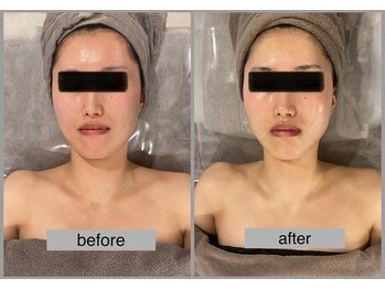 ブリノス(BLINOSS)/ブライダルエステ