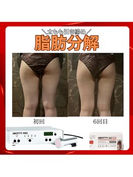 トータルビューティーサロン ヴィヴィエ(ViVier)/脂肪分解　太もも症例9回