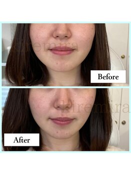 キレミラ 麻布十番店/左右差編