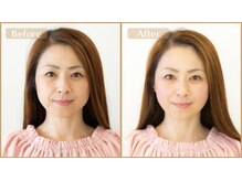 グラン治療院 東京/美容鍼　ビフォーアフター