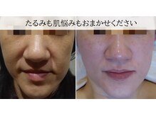 ラグランシエル(Le grand ciel)/くすみ×リフトアップ