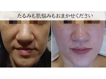 ラグランシエル(Le grand ciel)/くすみ×リフトアップ