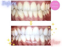 エクシアホワイトニング 天王寺店/ホワイトニングビフォーアフター