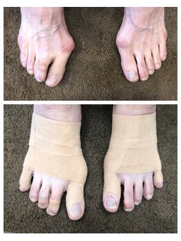 エターナル巻き爪金沢/アーチテーピング