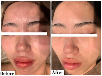 フレイヤ(FREYA)/ララピールBefore→After