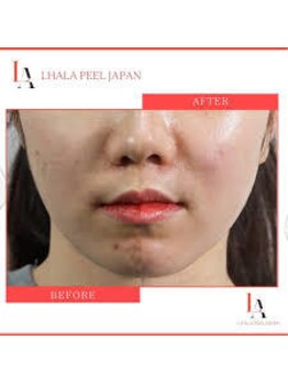 チャマ 高知店(CHAMA)/ララピール×LDMは当店のみ☆