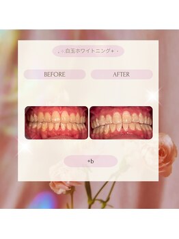 プラスビー 2号店(+b)/ホワイトニングビフォーアフター