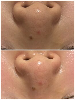 ナナラ(NANALA)/みんな気になる毛穴