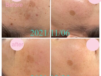 サクラ(SAKURA)/30代シミケア