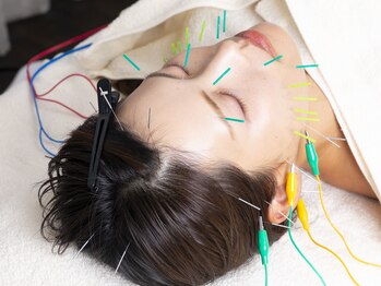 リウム(Lium)の写真/美容鍼灸でリフトアップ、憧れの小顔に!頭にも鍼をすることで眼精疲労や不眠のケアとしてもおすすめ♪